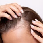 Dermatologdan İpuçları: Mevsimsel Saç Dökülmesinin Sebepleri Neler?